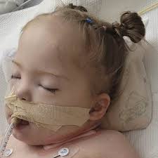 4-year-old with Down syndrome battles for life after getting COVID-19, RSV