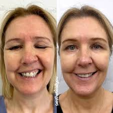 🧠 How does it feel after your first treatment Dr. Singh? 𝗘𝗫𝗢𝗠𝗜𝗡𝗗  with NeuroSurgeon, Dr. Mohamed Abdulhamid & Dr. Raj Singh MD:  Revolutionizing Mental Wellness! 🧠 Treating DLPFC (or Dorsolateral  Prefrontal Cortex)