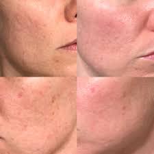 Acne scars before and after chemical peel. 20 Years With Cystic Acne And Acne Scars Left Pictures Taken In September 2019 Right In December 2019 Right Pictures Are Are After 1 Chemical Peel And 1 Micro Needling Acnescars