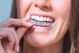 Benefits of Choosing Invisalign Over Traditional Braces