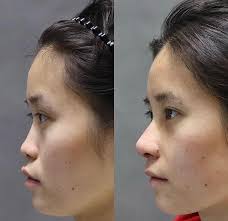 隆鼻真的是五官裡面最值得投資手術項目第一個