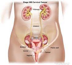 Screeningexternal icon means checking your body for cancer before you have symptoms. Cervical Cancer Treatment Pdq Treatment Patient Information Nci Cs Mott Children S Hospital Michigan Medicine