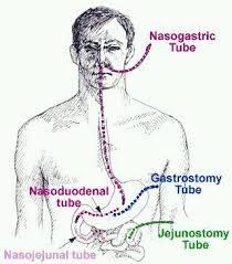 Pin By Kathy Kincaid On Nurse Hints Enteral Feeding Nursing Care Nursing Care Plan