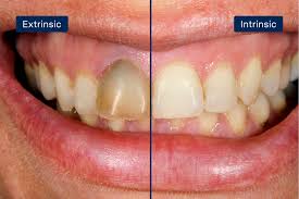 Image result for Tooth Discoloration