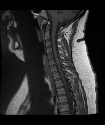 Pinched nerves come in all different types and magnitudes. Cervical Disc Prolapse Radiology Case Radiopaedia Org