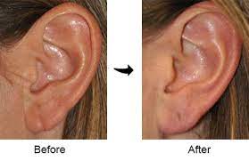 Earlobe Repair Virginia Washington D C And Maryland