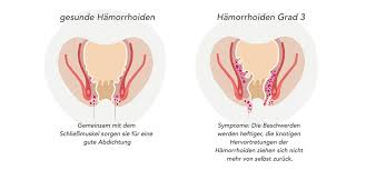 Bei sichtbarem blut am after oder auf dem stuhl, und auch bei positivem test auf unsichtbares blut ist immer eine genaue diagnose durch den facharzt erforderlich. Hamorrhoiden Was Tun Shop Apotheke