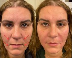Dermal fillers for marionette lines