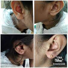 5 Year Pretty Girl Was At Our Medical Centre Yesterday For Ear Piercing Drayeshafaizan Earpiercing Nosepiercin Dermatologist Medical Tourism Ear Piercings