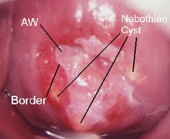 Image result for Colposcopy Findings