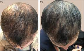 That hair is going to grow back once. Microneedling In Androgenetic Alopecia Comparing Two Different Depths Of Microneedles Faghihi 2021 Journal Of Cosmetic Dermatology Wiley Online Library