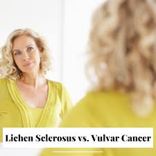 Image result for Vulvar Cancer