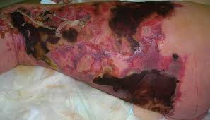 In most cases a urologic, colorectal, or cutaneous source can. Necrotizing Fasciitis Wikipedia
