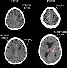 Stroke series video 3 of 7: Ct Scan Features Of Ischemic Stroke Ct Scan Machine