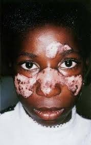 Find causes diagnosis and treatments for lupus i have to say the vitamin d pills i take. African Americans Lupus Pics Google Search Lupus Rash Vitiligo Photos Vitiligo