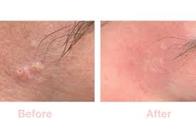 Image result for Sebaceous Hyperplasia