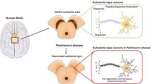 Parkinson's disease is a progressive neurological disorder. Parkinson S Disease Is Gene Therapy The Answer We Have Been Looking For Asgct American Society Of Gene Cell Therapy
