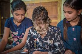 A very rare and unfamiliar disorder referred to as hypertrichosis characterized by abnormal hair growth on the body to the extent that it nearly covers all skin except on areas like soles, hands and feet. Inkl Sixteen Children Develop Werewolf Syndrome From Taking Contaminated Medicine On Spain S Costa Del Sol The New Zealand Herald