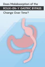 Does Malabsorption Of The Roux En Y Gastric Bypass Change Over Time Gastric Bypass Rny Gastric Bypass Gastric Bypass Meal Plan