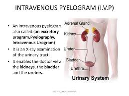 Image result for Intravenous Pyelogram