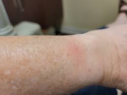 Go on to discover millions of awesome videos and pictures in thousands of other. My Samsung Galaxy 3 Watch Got So Hot It Burned My Wrist Samsung