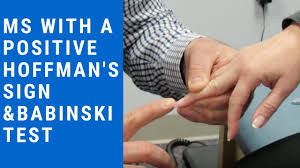 The cause of multiple sclerosis is currently unknown. Hoffman S Sign What Do Positive And Negative Test Results Mean