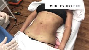 They work very well with me on. Lipo 360 At Atlanta Liposuction Speciality Clinic Youtube