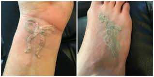 Again, depending on the size, location and type of tattoo being removed, you may need only a few sessions or several. Experience With Picosure Laser Tattoo Removal Nyc