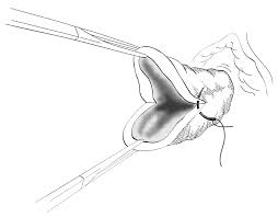 Image result for Friable Cervix