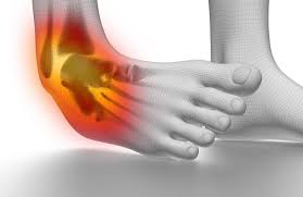 Exercise After a Sprained Ankle ...