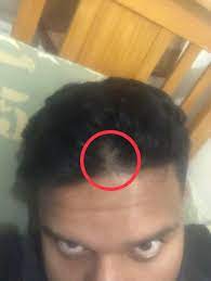 In this article, you'll learn more about scalp tingle and what it means for you. My Barber Noticed My Hair Thinning From The Front But Didn T See It As A Serious Sign Of Baldness Would Any Scalp Masks And Serum Oils Help To Regrow My Hair Hair