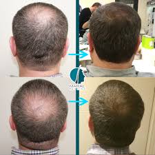 This type of hair is naturally bone straight and not typical of black hair. Grade 3 Grade 3 Vertex Grade 4 Hair Loss Maral Hair
