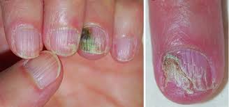 Overview Of Nail Disorders Skin Disorders Msd Manual