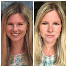 Rowe Casa Organics products for acne and scarring