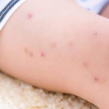 Contrary to popular belief, chiggers do not infiltrate human skin. Fleas Ticks And Chiggers What S The Difference Summer Pest Prevention