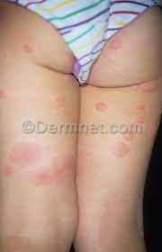 Pin On Cobalt Allergy