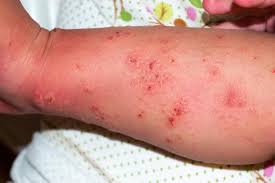 Image result for scabies symptoms