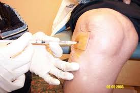 Image result for Knee Joint Injection