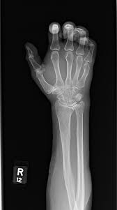 Ulnar Styloid Impaction Syndrome - Cause, Symptoms, Treatment