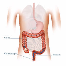 Usually, the cost of colonoscopy is cheaper in government hospitals. Colonoscopy Grace Hospital Tauranga New Zealand