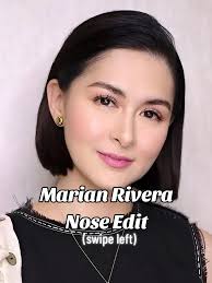 Marian Rivera Surgery