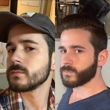 Is your beard and minoxidil the secret to make a patchy beard full? Results Of Using Minoxidil For One Month Minoxbeards