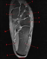 • muscle edema is seen secondary to multiple etiologies including trauma, infectious and inflammatory processes, autoimmune disorders, neoplasms, and denervation injuries • on mri muscle edema is characterized by increase in free water within the muscle • muscle edema is seen on mri as increased signal on fluid sensitive sequences t2 fs Mri Of The Ankle Detailed Anatomy W Radiology