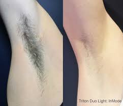 Hyperpigmentation, blistering, and irritation are possible side effects in all users. The Best Laser Hair Removal In Newnan And Metro Atlanta