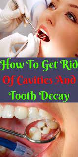 How To Get Rid Of Cavities And Tooth Decay Tooth Decay Dental Cavities Cavities