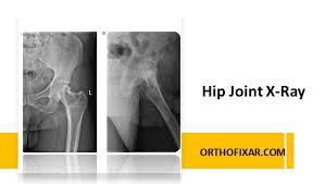 Image result for Hip XRay