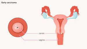 Pap tests have reduced the number of deaths due to cervical cancer by more than 50%. Cervical Cancer Causes Symptoms Prevention And Treatment