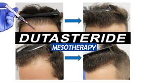Hopefully taking avodart (dutasteride) twice a week will be enough to halt your hair loss without any side effects. Mesotherapy With Dutasteride Injections Pros And Cons And What Results To Expect Youtube