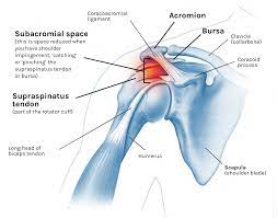 This impingement damages the soft tissues and can lead to pain, inflammation and reduced movement of the arm. Got Shoulder Impingement Do These 2 Exercises Tom Morrison