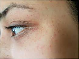 Purpura may also occur in the mucous membranes, especially of the mouth and in the internal organs. Postictal Periorbital Petechiae Canadian Journal Of Neurological Sciences Cambridge Core